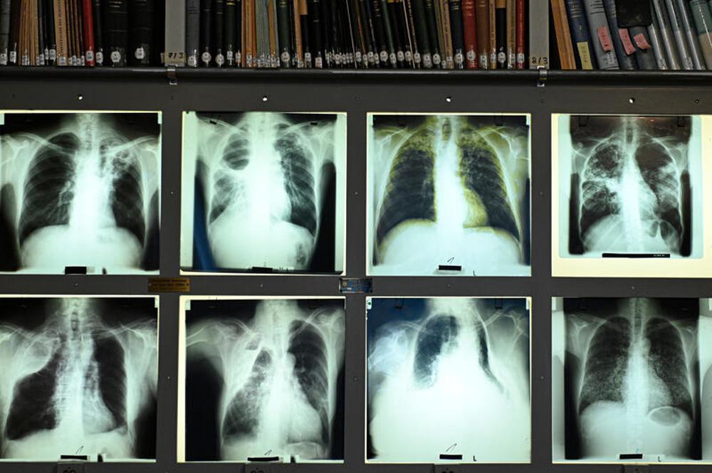 Röntgenbilder von Tuberkulose-Kranken im Tuberkulose Museum Heidelberg (Archivbild)